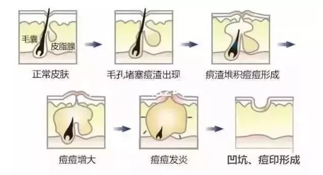 如何祛除痘坑？祛除痘坑最好的方法