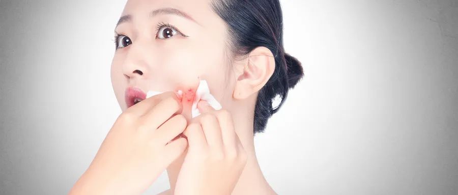 如何預防粉刺的發(fā)生和痤瘡的形成？