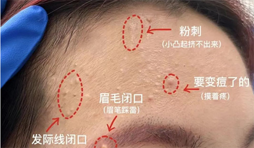 臉上經(jīng)常長(zhǎng)閉口粉刺的原因有哪些？