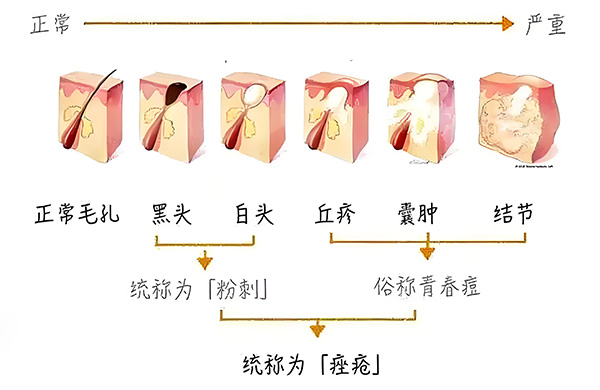 黑頭怎么去除最有效？去除黑頭最有效的方法
