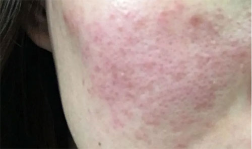 皮膚泛紅癢是什么原因？皮膚紅癢怎么回事？