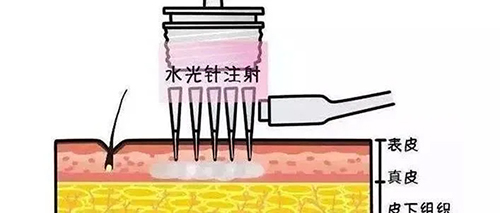 水光針的類型有哪幾種？