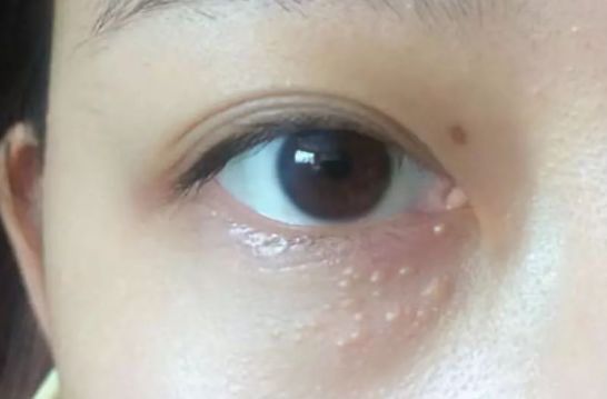 為什么眼部容易長(zhǎng)脂肪粒？