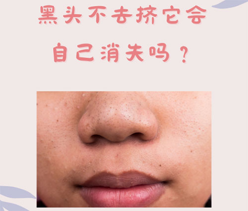 什么是黑頭？怎樣預(yù)防黑頭的形成？