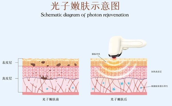 光子嫩膚術(shù)前注意事項有哪些？